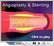 angioplasty